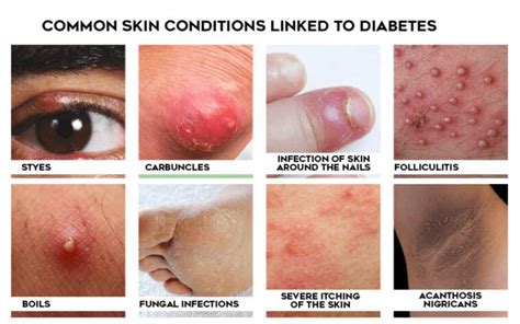 Specific Skin Conditions Linked to Diabetes