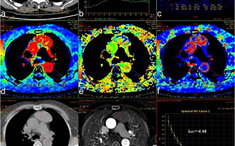 Spectral Ct Imaging: Differentiating Tissue Types Based On Energy Absorption