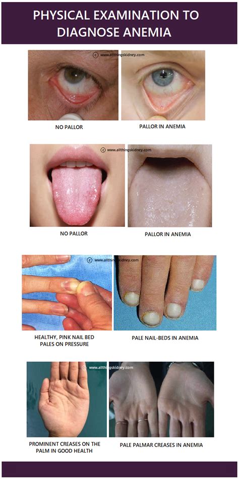 Spot Anemia Symptoms: Quick Self-Check Tips