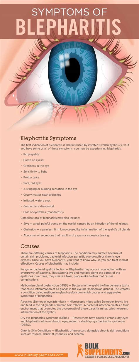 Spotting the Signs of Blepharitis