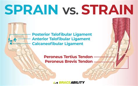 Sprains and Strains