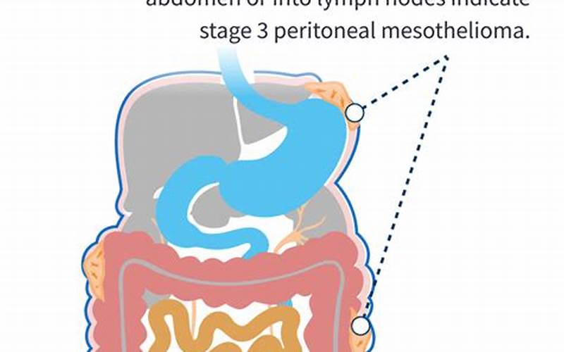 Stage 3 Peritoneal Mesothelioma Pic