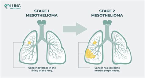 Stage 2 Moderately Advanced Mesothelioma