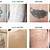 Stages Of Tattoo Removal