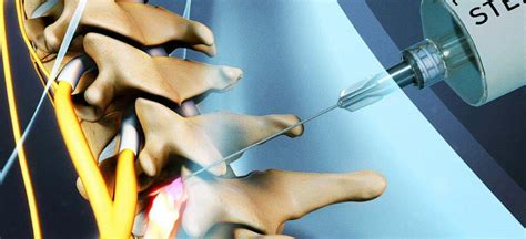 Steroid Injections/Implants