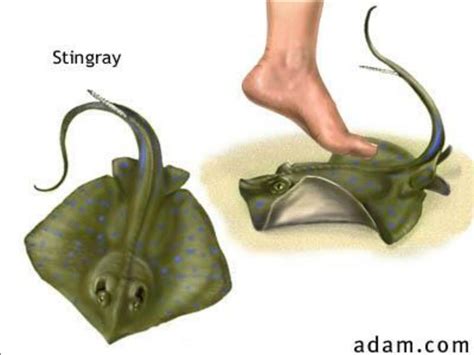 Stingray Stings: Fast First Aid & Relief