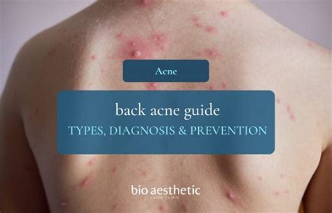 Stop Back Acne: Prevention & Clear Skin
