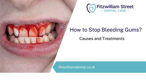 Stop Bleeding Gums: Causes & Treatments