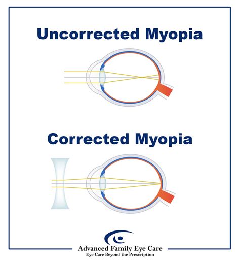 Stop Myopia: Vision Correction & Prevention Tips.