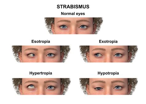 Strabismus: Causes & Solutions for Adults, Kids