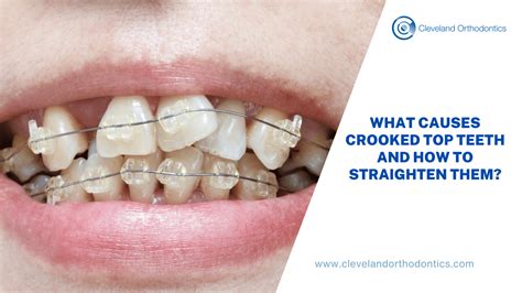 Straighten Teeth: Causes & Effective Treatments