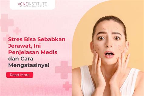 Stres jerawat