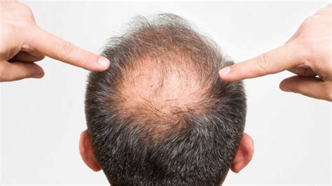 Stress and Male Pattern Baldness