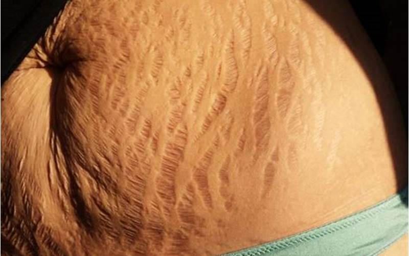Stretch Marks On A Woman'S Stomach