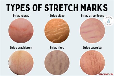 Can stretch marks be prevented? The Nation Nigeria