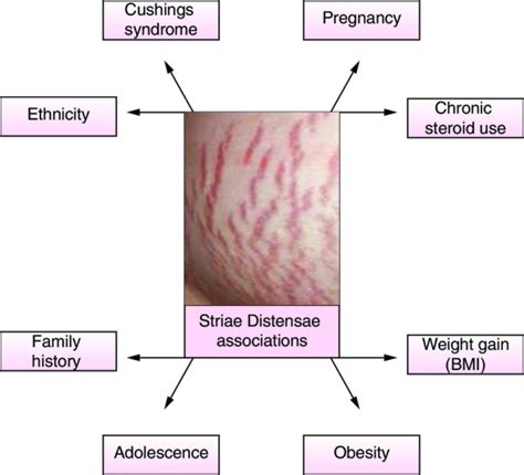 Stretch Marks: Causes & Prevention Solutions