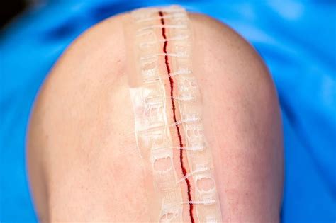 Revolutionize Your Wound Healing Experience with Stryker Zip Skin Closure - The Ultimate Solution for Effortless and Painless Closure!