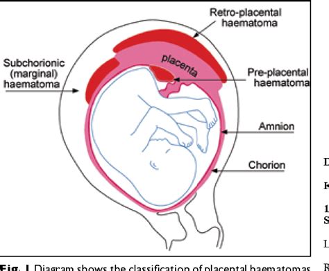 Subchorionic Hematoma and Cervical Changes