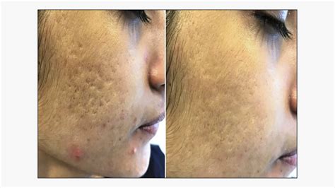 Subcision Treatment for Acne Scars