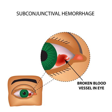 Subconjunctival Hemorrhage (A Common Concern)