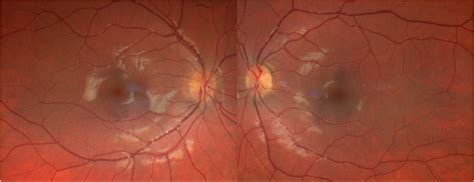 Subtle Clues in Fundus Photography