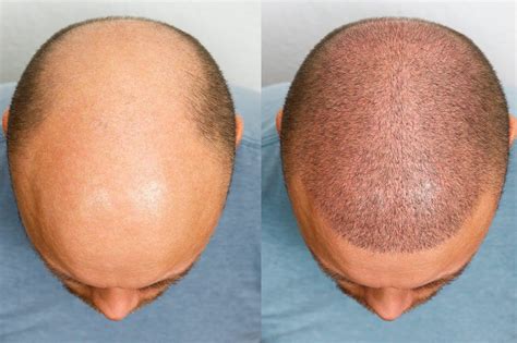 Successful Hair Restoration