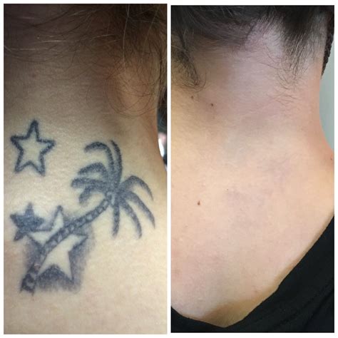 5 Tips for Successful Laser Tattoo Removal in Toronto HD