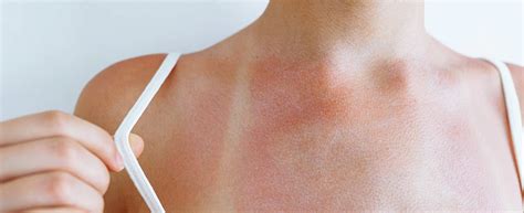 Sun Sensitivity & Xeroderma Pigmentosum: Solutions