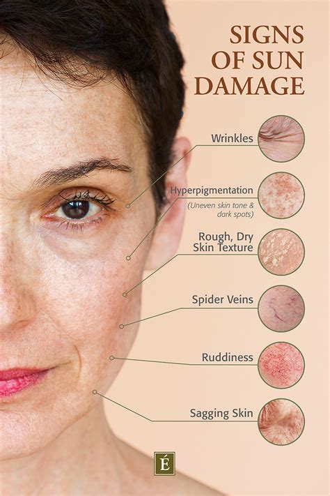 Sun-Damaged