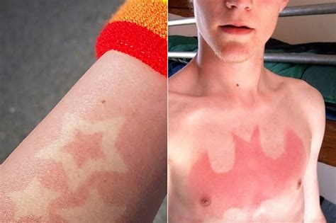 Sunburn And Tattoos
