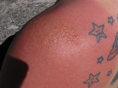 Everything about sunburn on tattoo Treatment, Protection