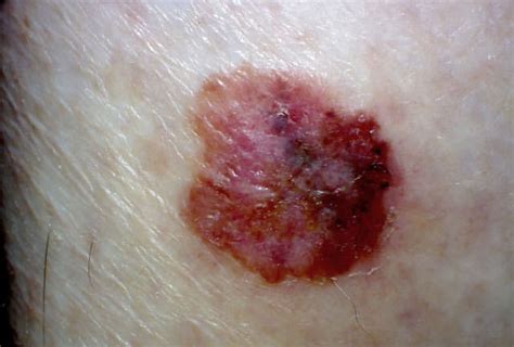 Unveiling the Mystery of Sunspots and Skin Cancer: Understanding the Risks and Prevention Measures