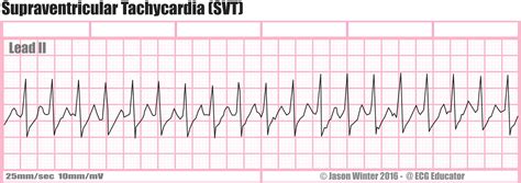 Tachycardia EKG Strip