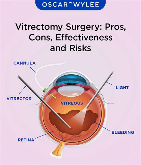 Surgery (Vitrectomy)