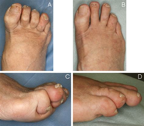 Surgical Options for Severe Claw Toes