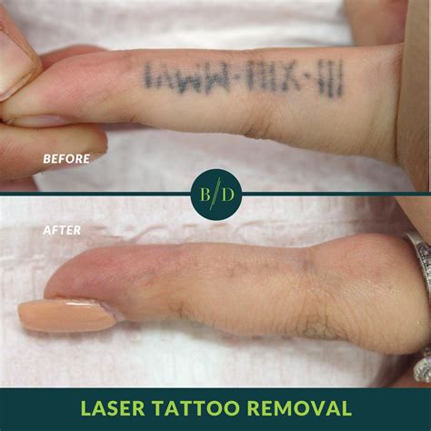 LASER Tattoo Removal Tattoo Surgery and other methods All