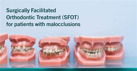 Surgically Facia Orthodontic (SFO)