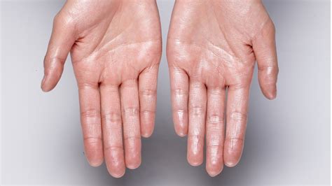Sweaty Hands & Heart Disease: What’s the Link?