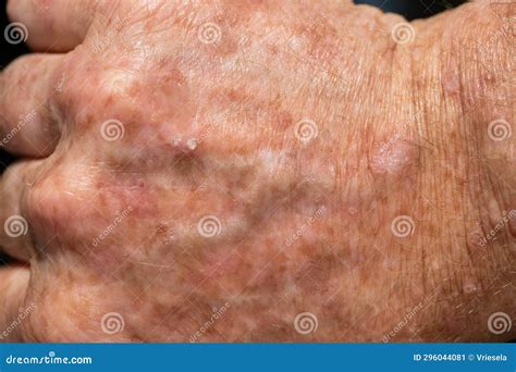 Swellings