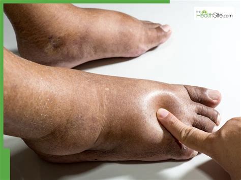 Swollen Feet: Hidden Causes & Fast Relief