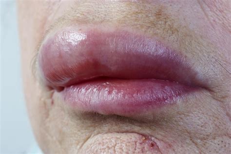 Bibir Bengkak