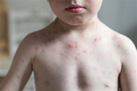Symptoms of Chickenpox and Shingles