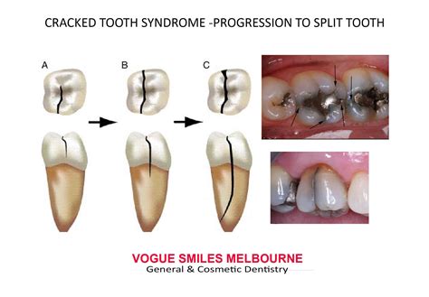 Symptoms of a Cracked Tooth