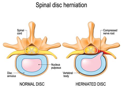 Symptoms of a herniated disc
