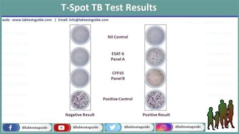 T-SPOT.TB Test and interpretation