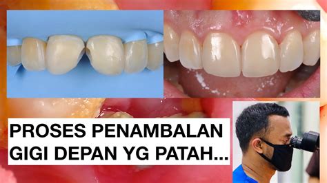 Tambalan Gigi Permanen