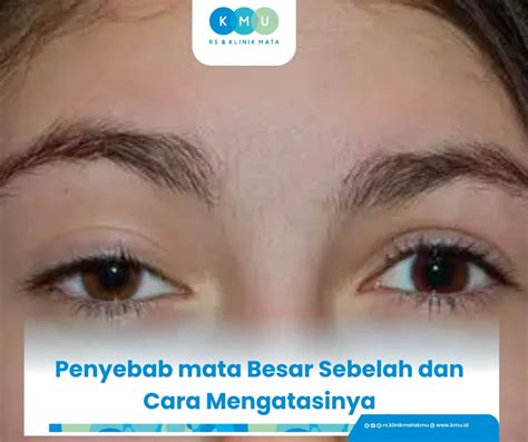 Tanda dan Gejala Mata Besar Sebelah
