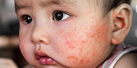 Tanda dan gejala alergi udang