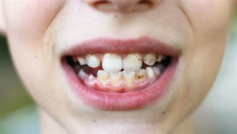 Tanda-tanda gigi keropos di usia muda