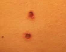 The Shocking Reality: The Horrifying Effects of Taser Marks on Human Skin